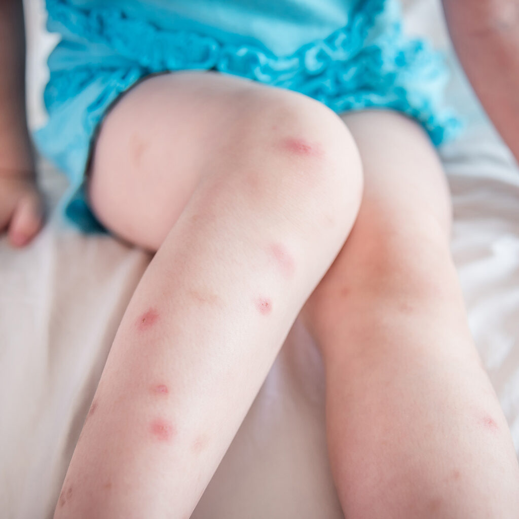 Multiple bedbug bites on a childs legs